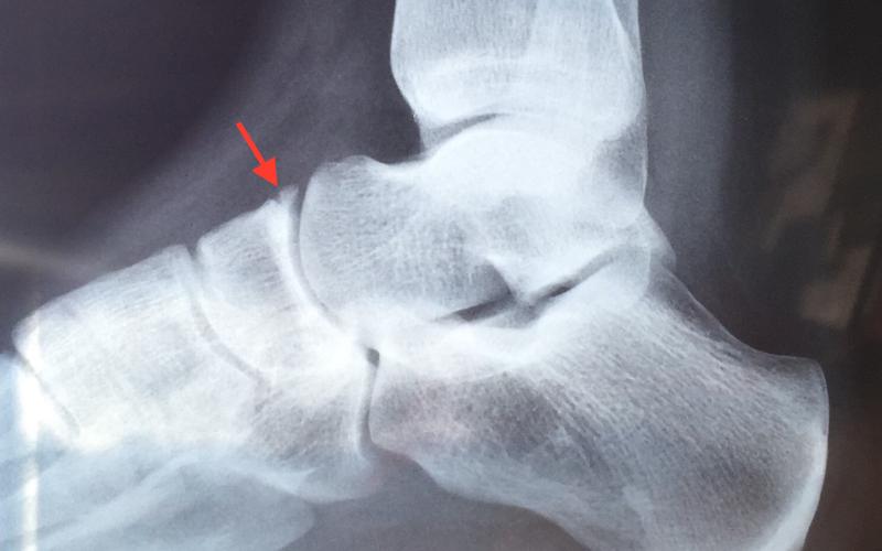 Mia's Foot