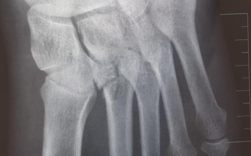 Smashed Foot