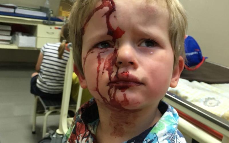 Can you Find the Wound in this 3 y/o?