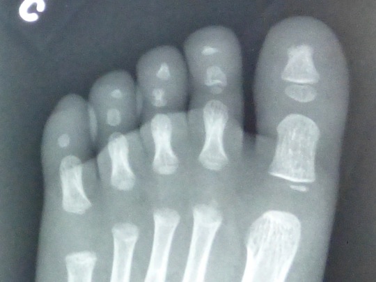 Samuel's Foot X-Ray